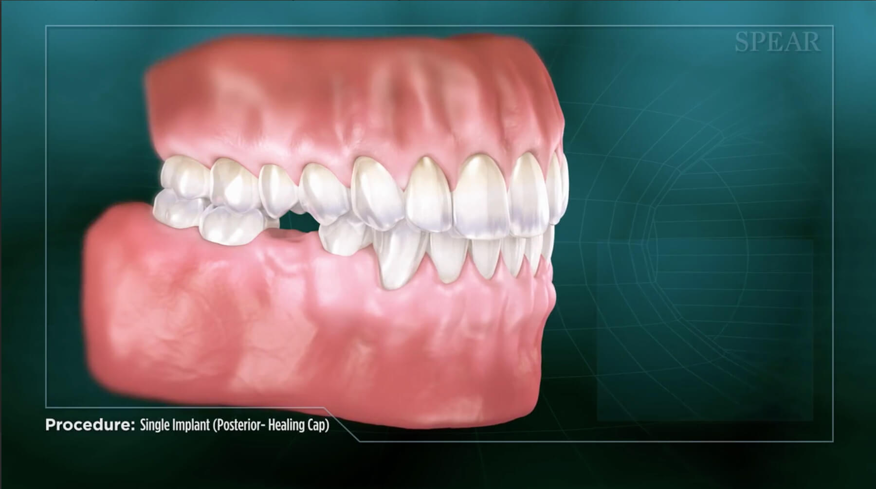 Video Preview of Dental Implants