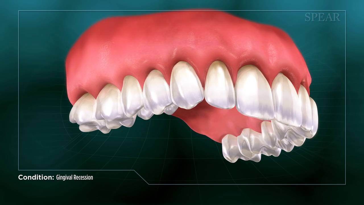 Video Preview of Gingival Recession