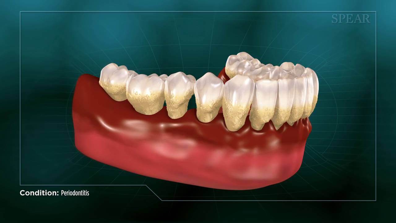 Video Preview of Periodontitis